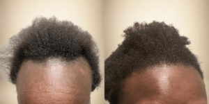 hair lose treatment