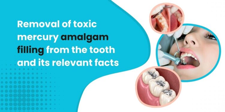 Removal of toxic Mercury Amalgam Filling From The Tooth and its Relevant Facts