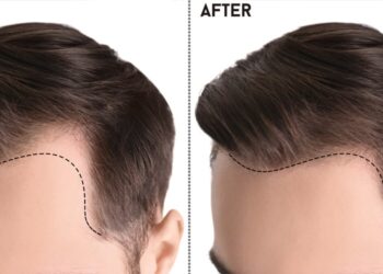 Hair Transplant in Islamabad