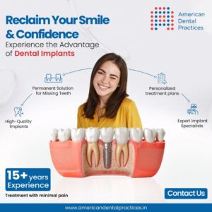 Dental Implants