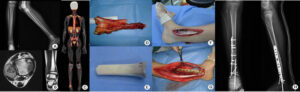 Ewing Sarcoma Surgery in India