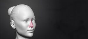 Rhinoplasty