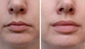 Lip and Cheek Enhancement: Dermal Fillers, Lip Augmentation, and Cheek Implants Explained