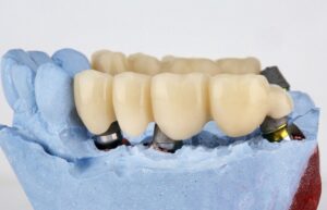 Dental Bridges: A Reliable Solution to Replace Missing Teeth