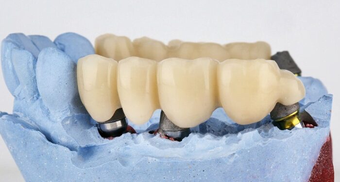 Dental Bridges: A Reliable Solution to Replace Missing Teeth