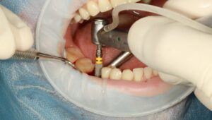 Everything You Need to Know About Single Tooth Implants