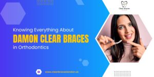 Knowing Everything About Damon Clear Braces in Orthodontics