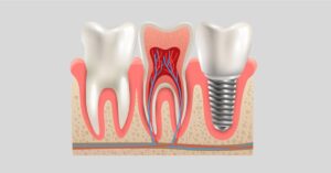 Dental Emergencies - Why It Is Important to See an Emergency Dentist