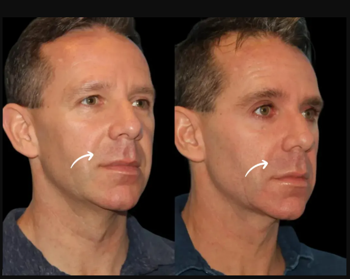 Sculptra Fillers Treatment in Dubai