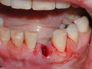 Tooth Extraction in Little Rock: What to Expect Before, During, and After
