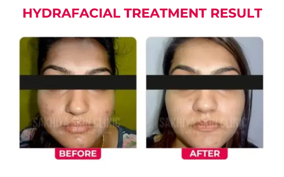 Benefits of Hydrafacial