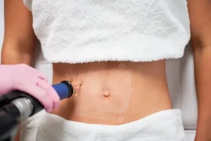 CO2 Laser for Stretch Marks