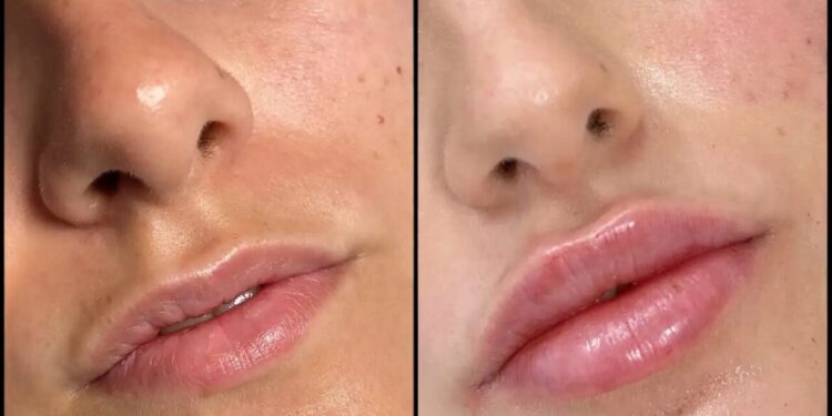 Fillers in Dubai