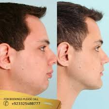 Jaw Surgery in Islamabad