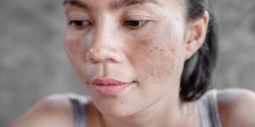 Does Pigmentation Treatment Lighten Sun Damage?