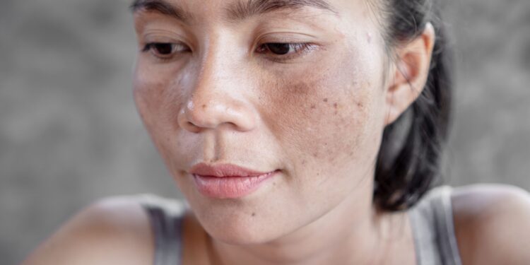 Does Pigmentation Treatment Lighten Sun Damage?