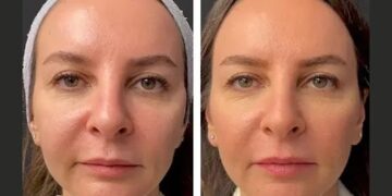 mesotherapy in dubai