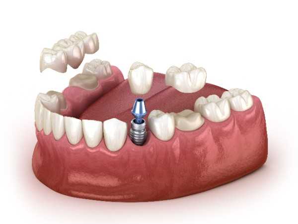 invisalign Muswell Hill 