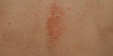 How Fast Do Shingles Symptoms Spread and What Can You Do?