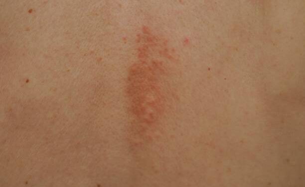 How Fast Do Shingles Symptoms Spread and What Can You Do?