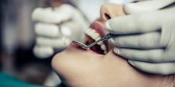 Tooth Extraction