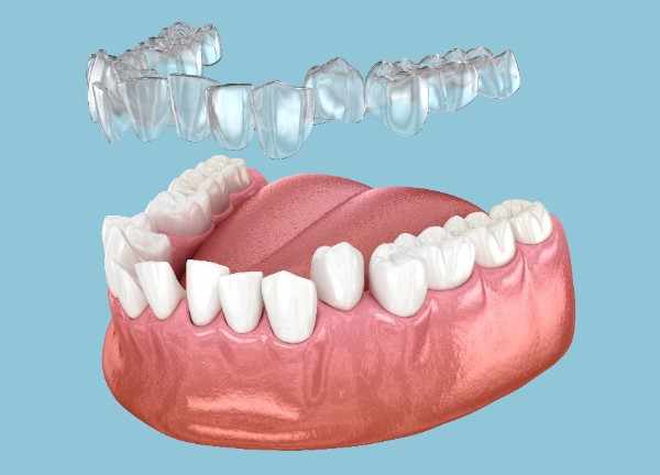 invisalign Muswell Hill 