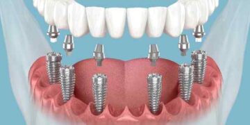 invisalign Muswell Hill